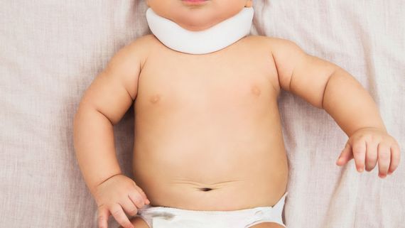 A baby with Torticollis.